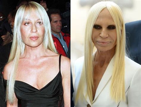 versace plastic surgeries|donatella before and after plastic surgery.